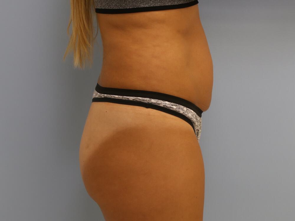 Buttocks Implants Before & After Image