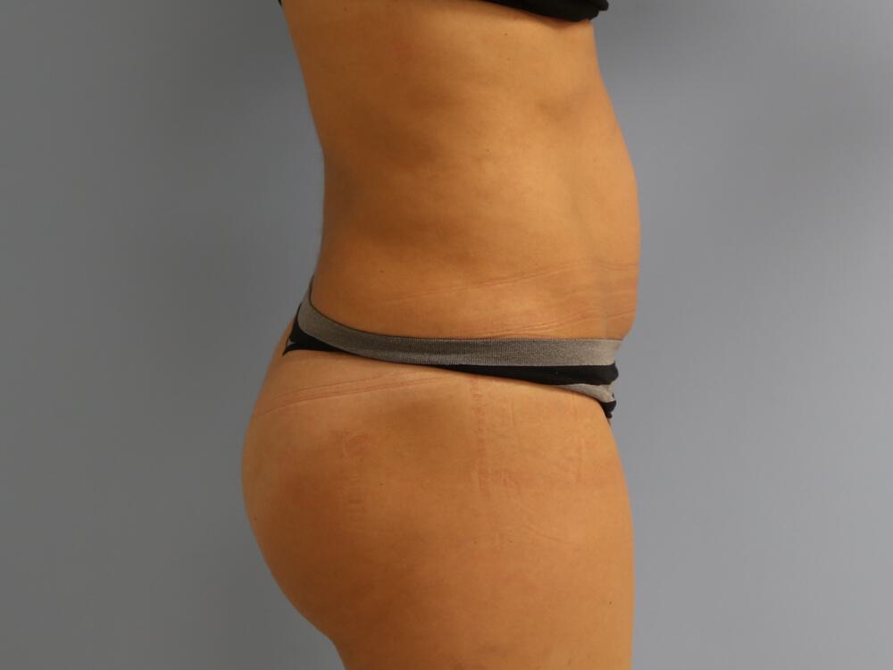 Buttocks Implants Before & After Image