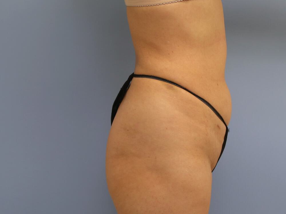 Buttocks Implants Before & After Image