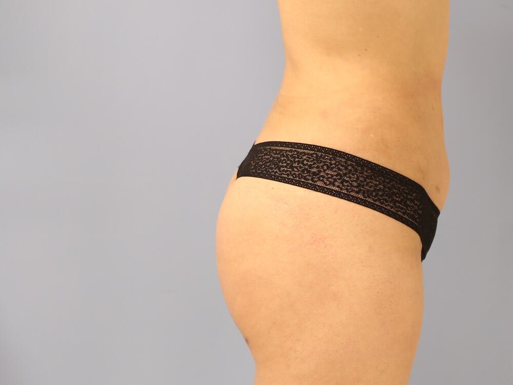 Buttocks Implants Before & After Image