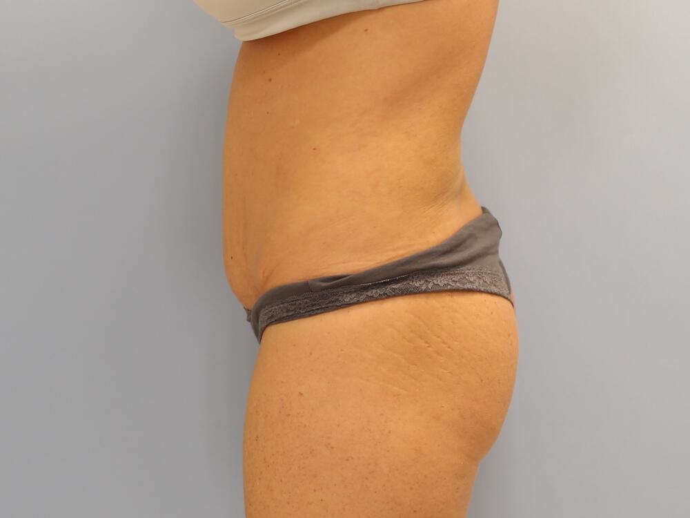 Buttocks Implants Before & After Image