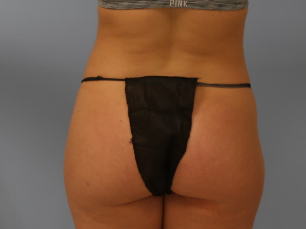 Buttocks Implants Before & After Image