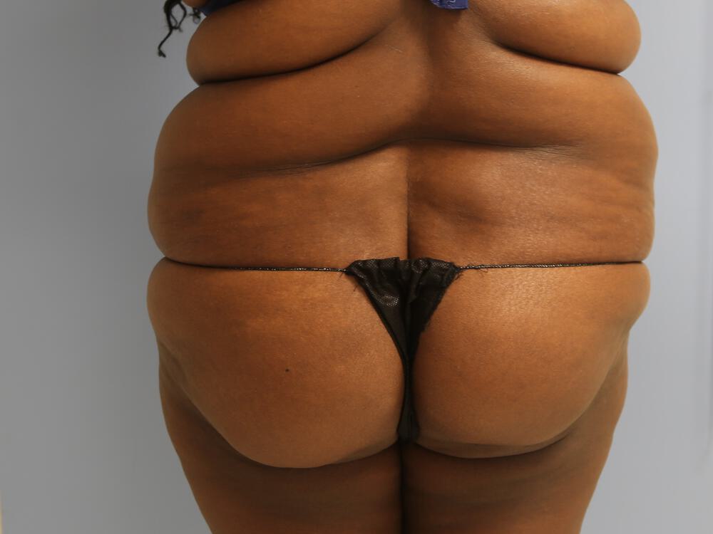 Buttocks Implants Before & After Image