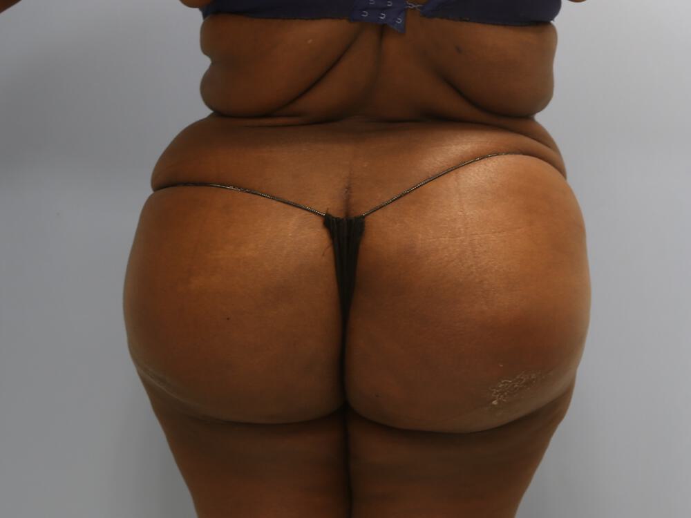 Buttocks Implants Before & After Image