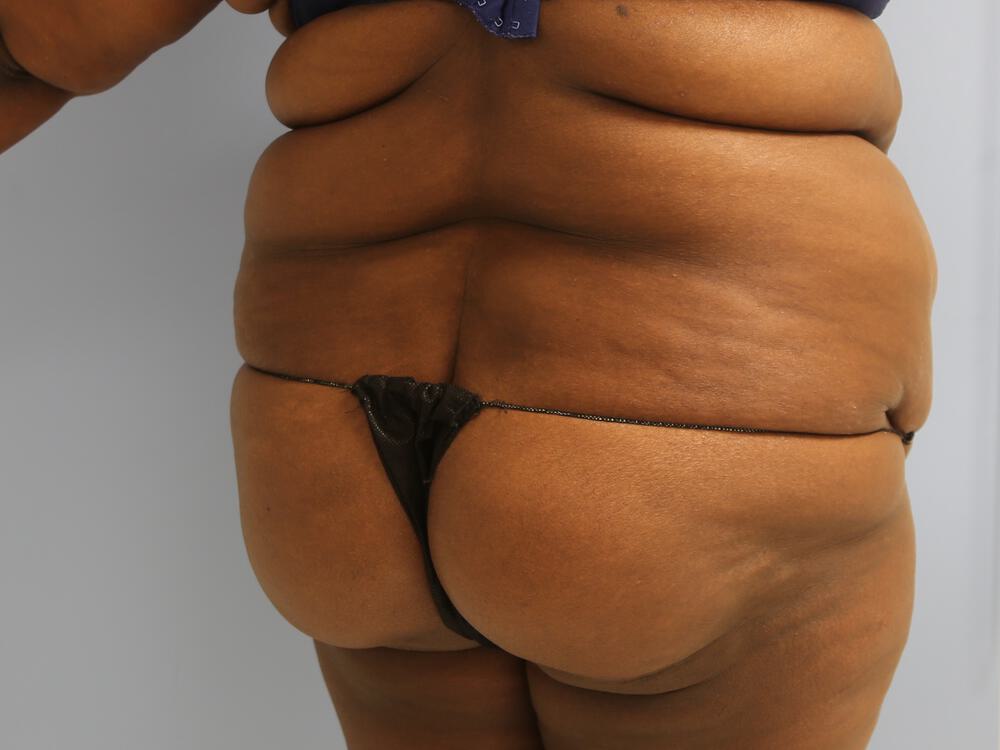 Buttocks Implants Before & After Image