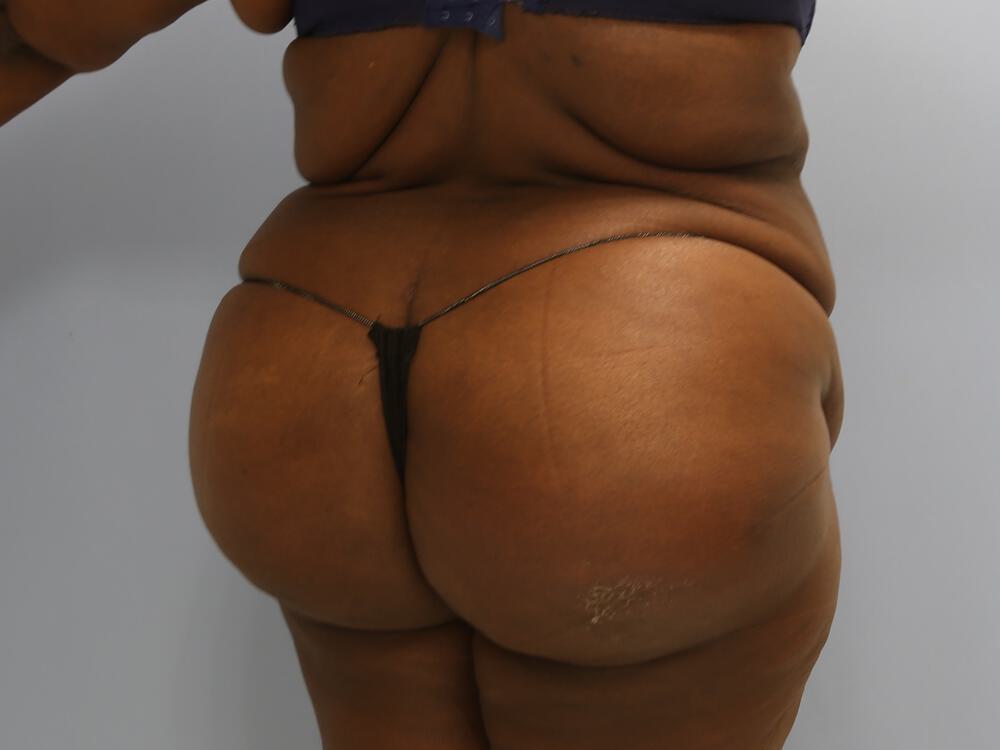 Buttocks Implants Before & After Image