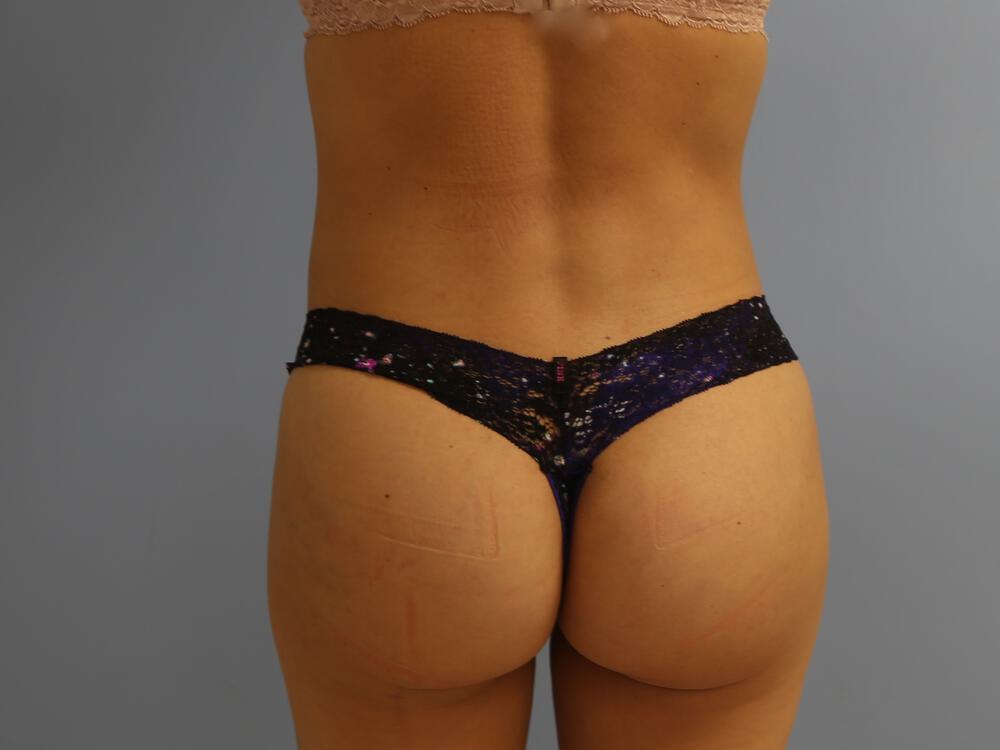 Buttocks Implants Before & After Image