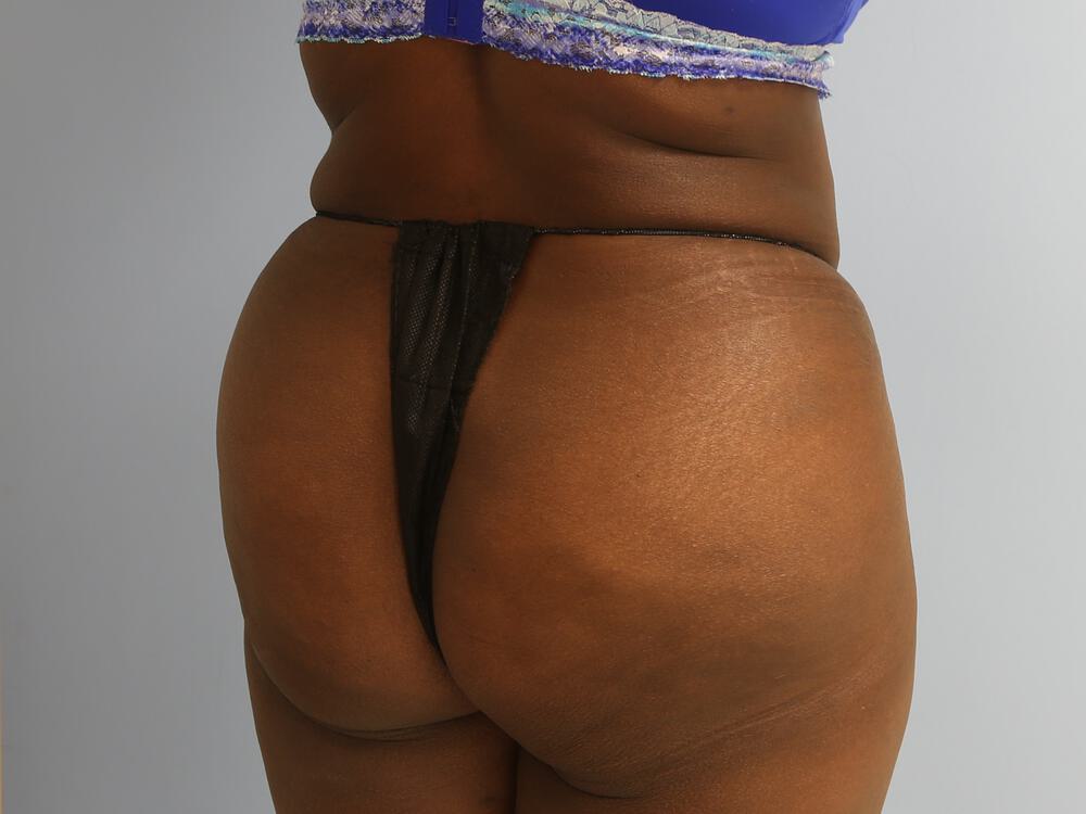Buttocks Implants Before & After Image