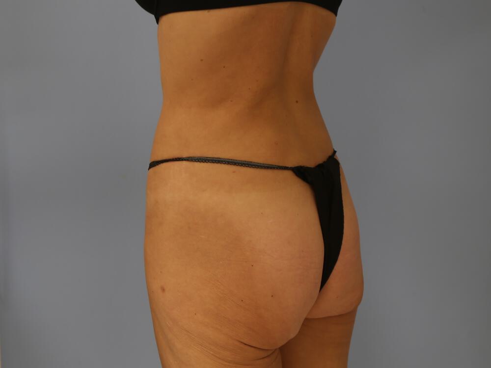 Buttocks Implants Before & After Image