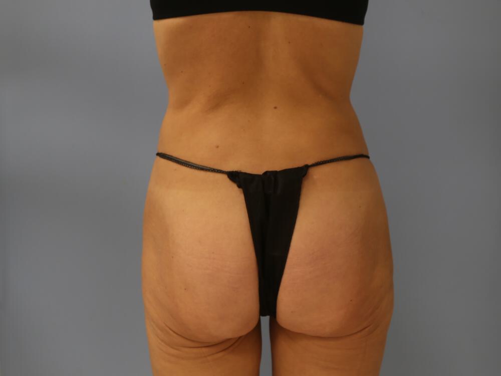 Buttocks Implants Before & After Image