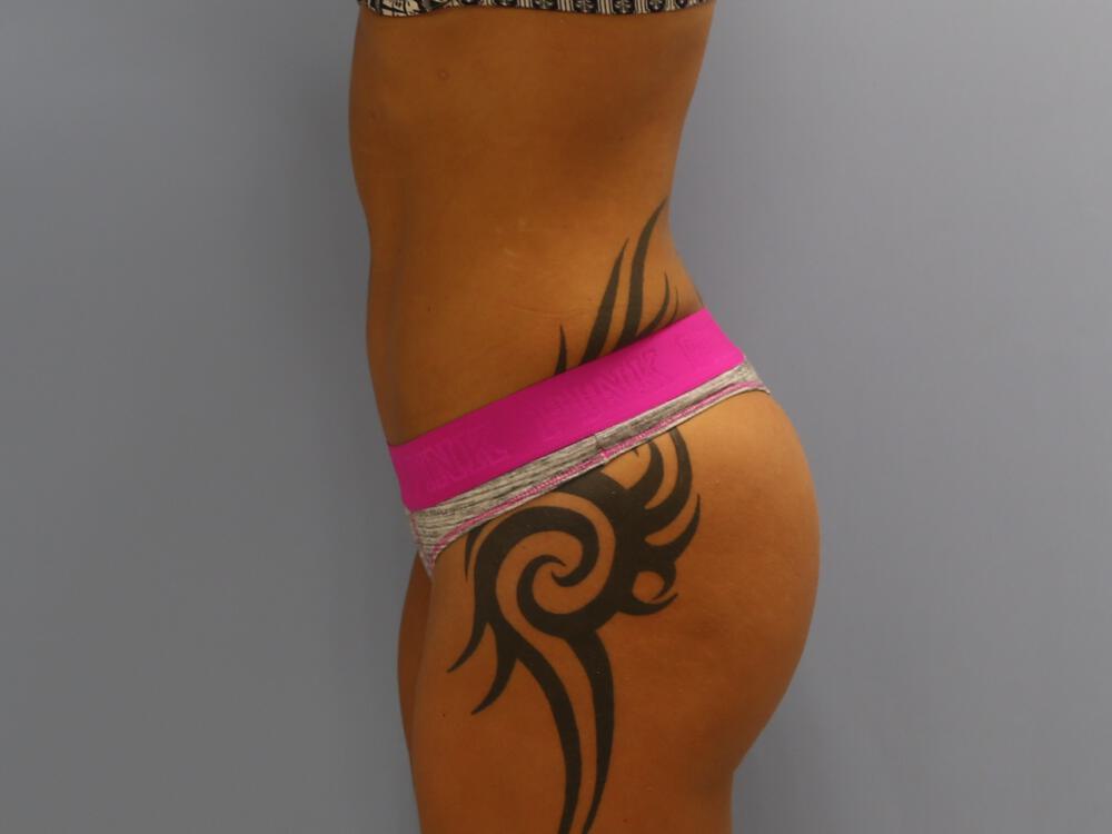 Buttocks Implants Before & After Image