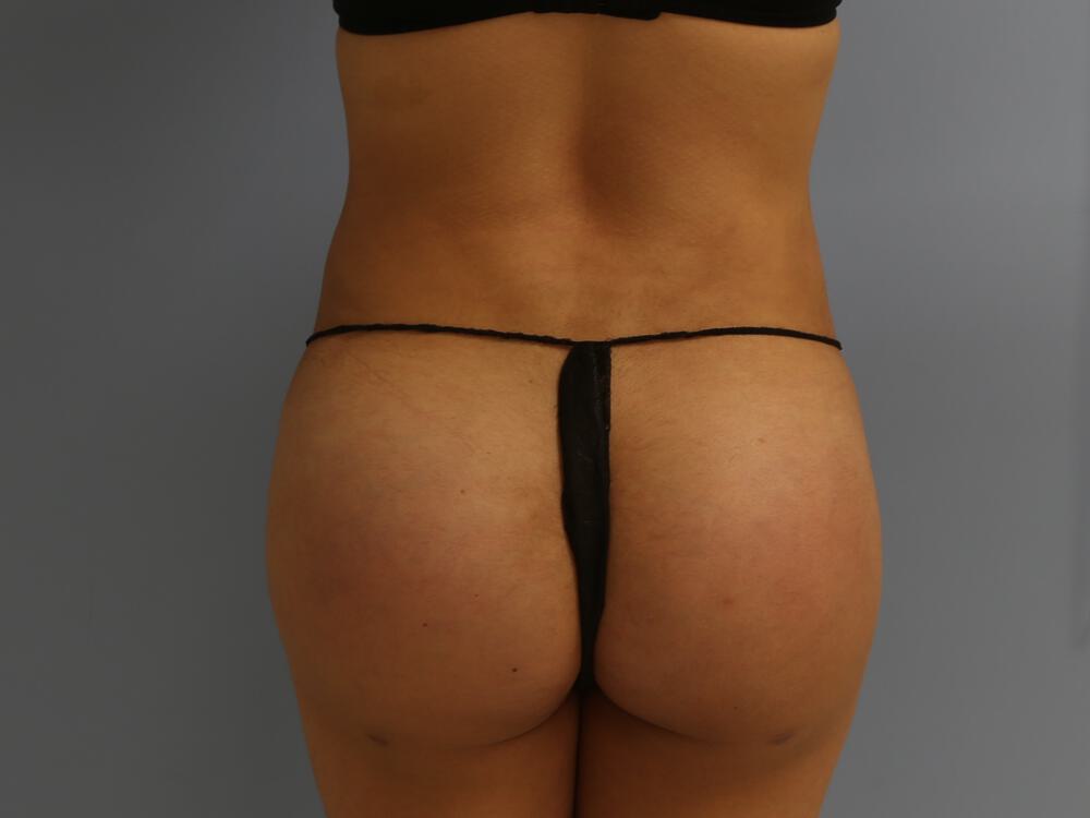 Buttocks Implants Before & After Image