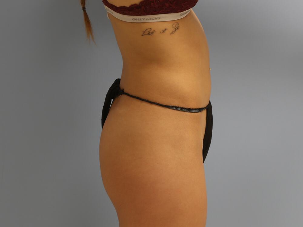 Buttocks Implants Before & After Image