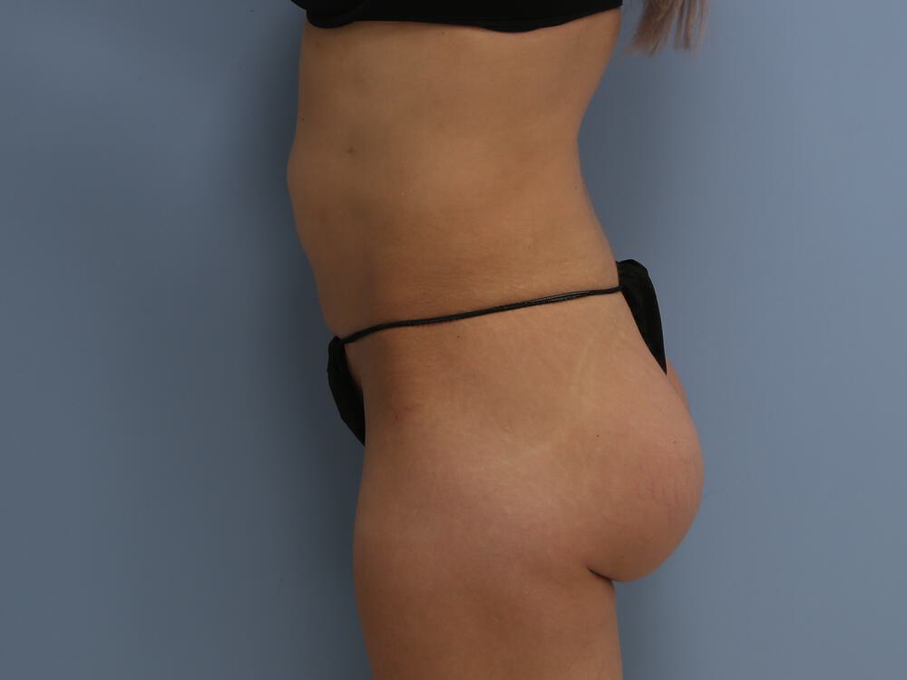 Buttocks Implants Before & After Image