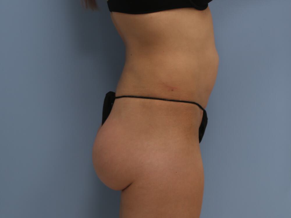 Buttocks Implants Before & After Image