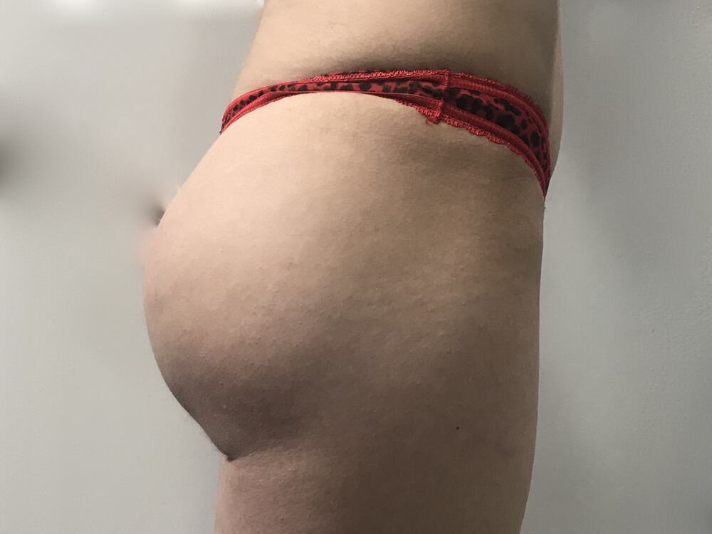 Buttocks Implants Before & After Image