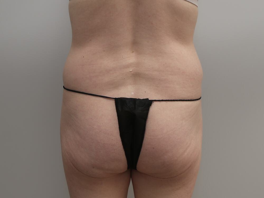 Buttocks Implants Before & After Image