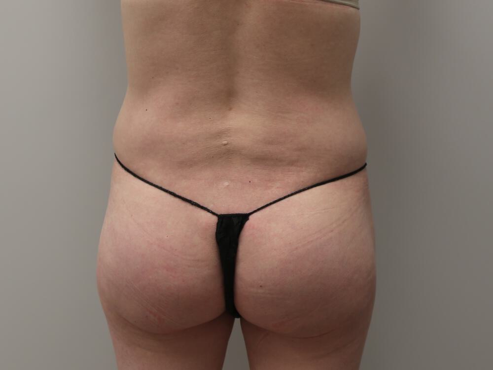 Buttocks Implants Before & After Image