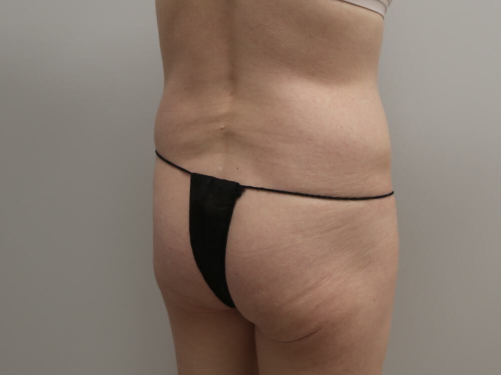 Buttocks Implants Before & After Image