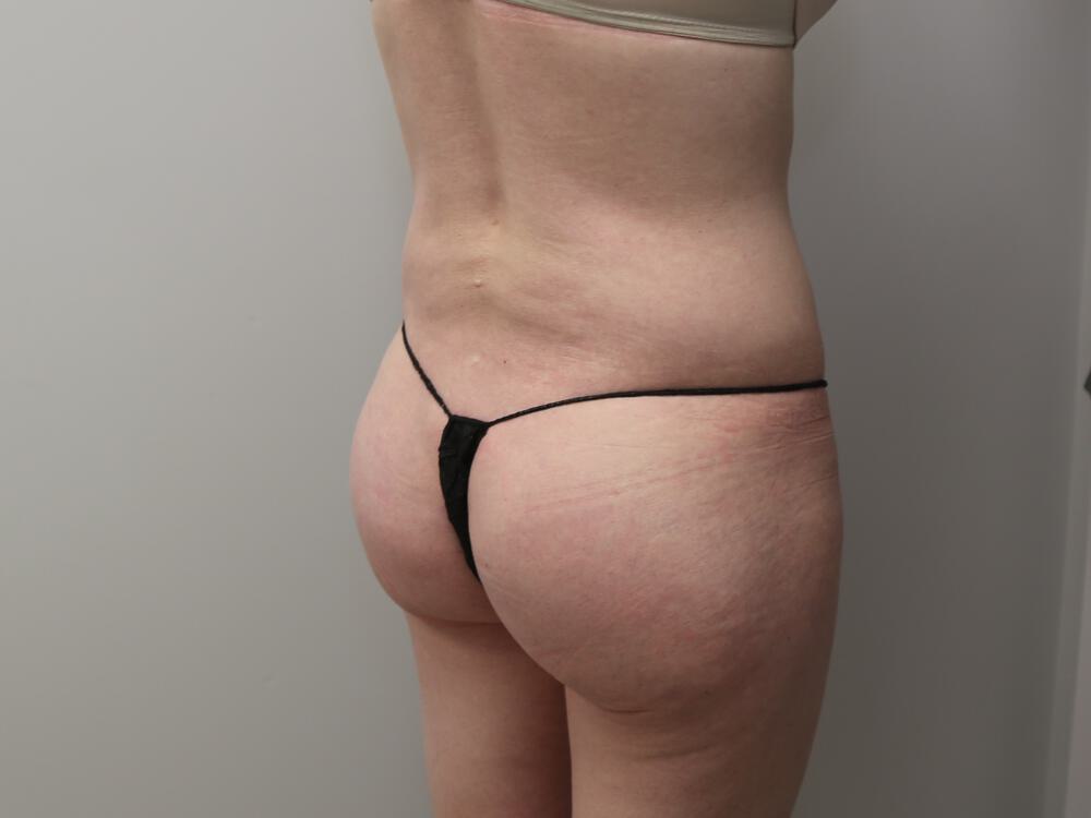 Buttocks Implants Before & After Image