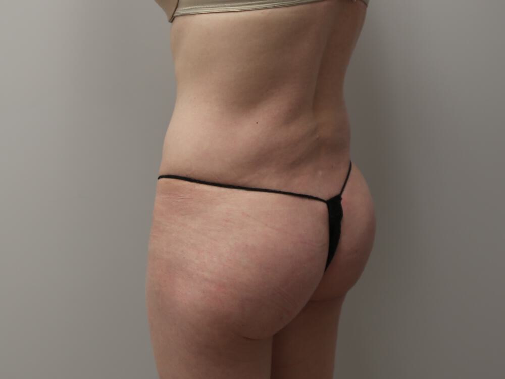 Buttocks Implants Before & After Image