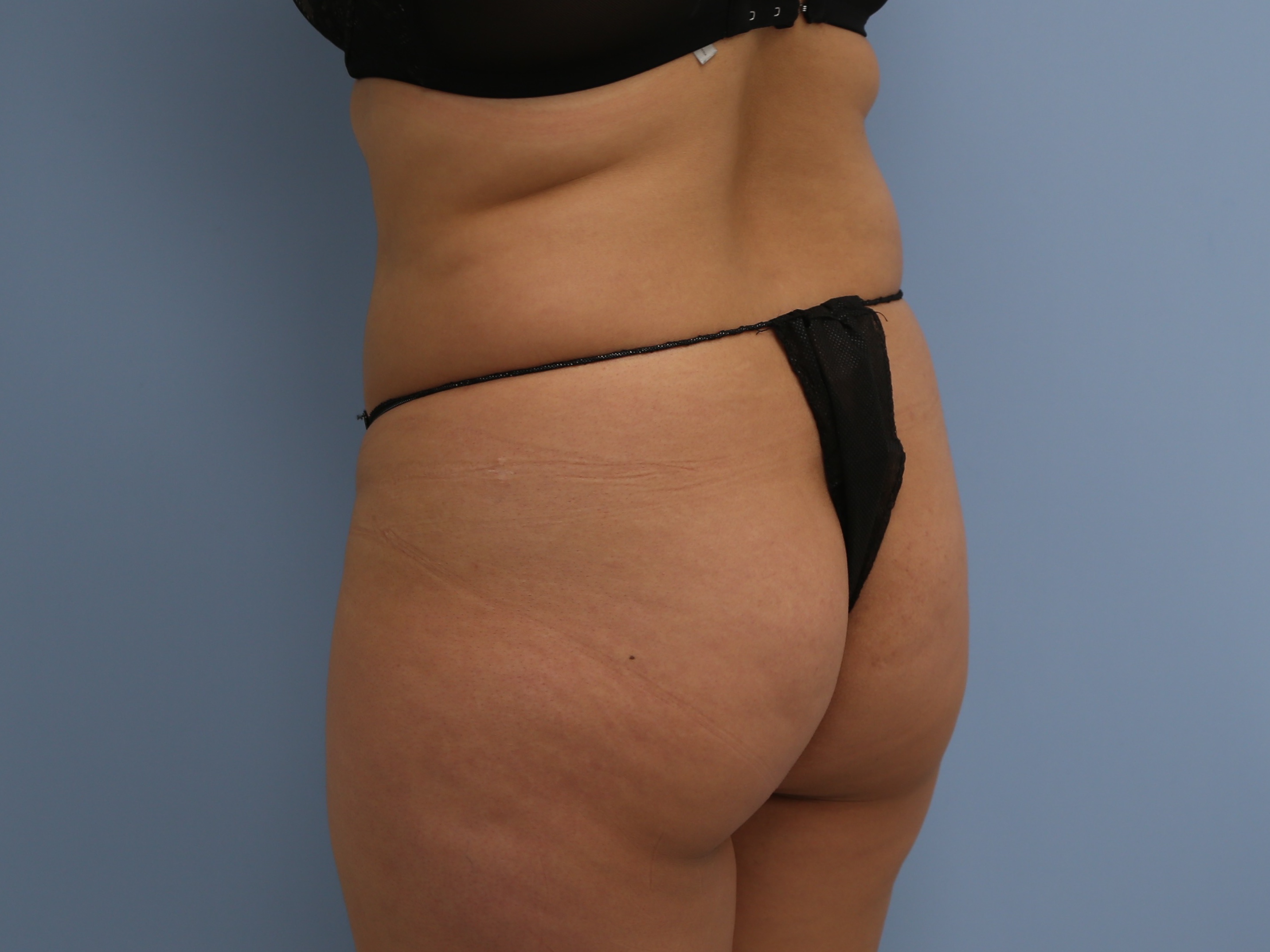 Buttocks Implants Before & After Image