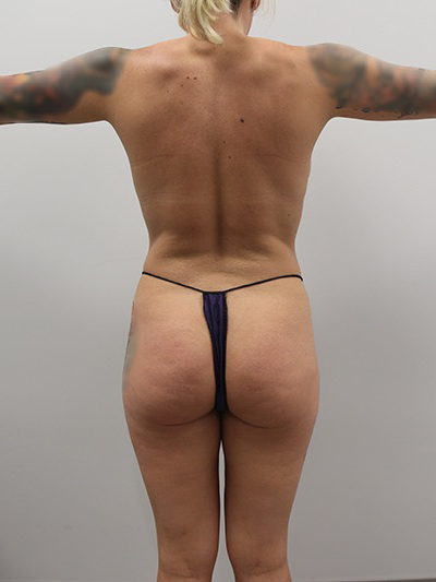 Buttocks Implants Before & After Image