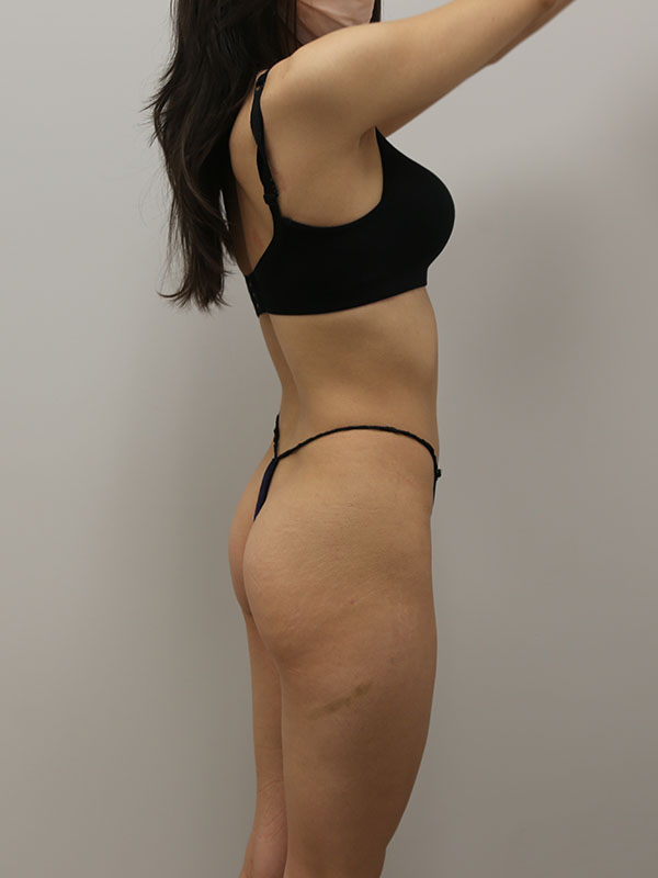 Buttocks Implants Before & After Image