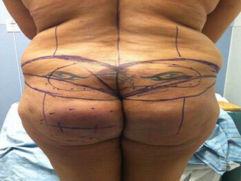 Buttocks Reshaping Before & After Image