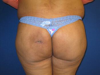 Buttocks Reshaping Before & After Image