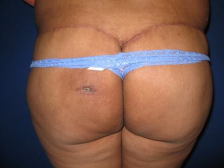 Buttocks Reshaping Before & After Image