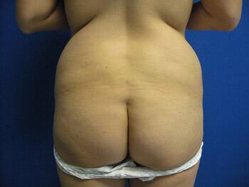 Buttocks Reshaping Before & After Image