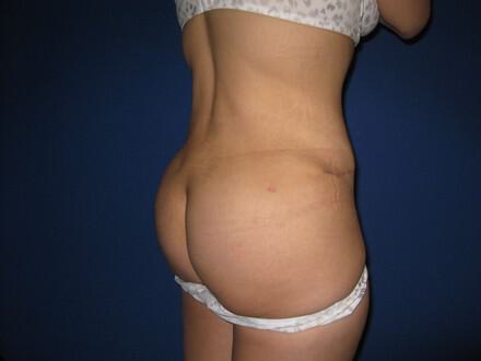 Buttocks Reshaping Before & After Image