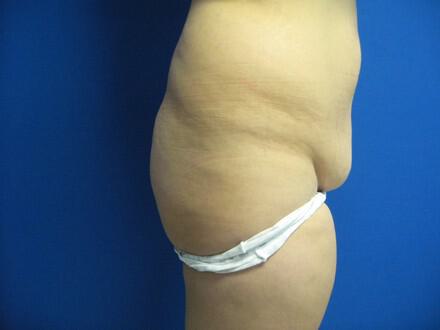 Buttocks Reshaping Before & After Image