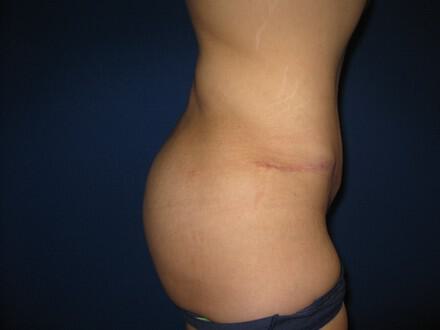 Buttocks Reshaping Before & After Image