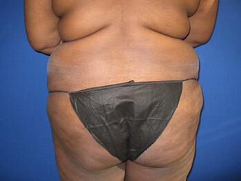 Buttocks Reshaping Before & After Image