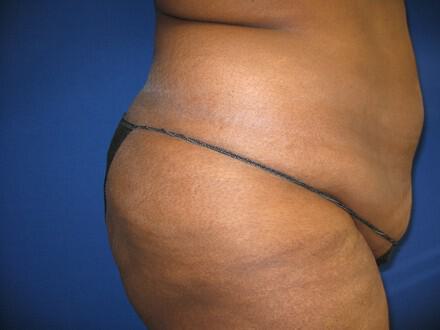 Buttocks Reshaping Before & After Image
