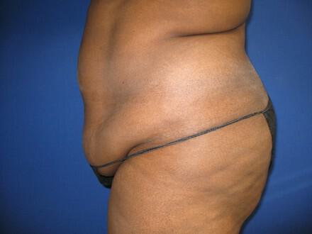 Buttocks Reshaping Before & After Image