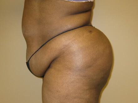 Buttocks Reshaping Before & After Image