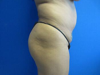 Buttocks Reshaping Before & After Image
