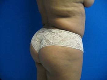 Buttocks Reshaping Before & After Image