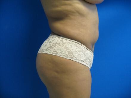 Buttocks Reshaping Before & After Image