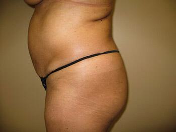 Buttocks Reshaping Before & After Image