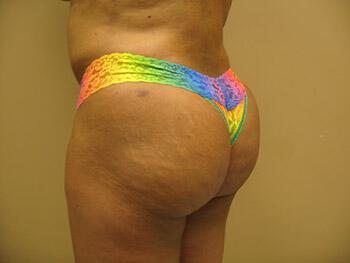 Buttocks Reshaping Before & After Image