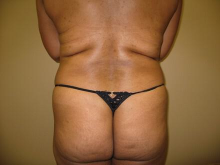 Buttocks Reshaping Before & After Image