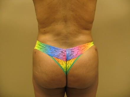 Buttocks Reshaping Before & After Image