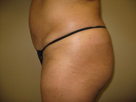 Buttocks Reshaping Before & After Image