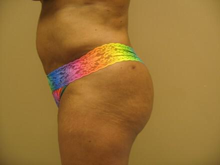 Buttocks Reshaping Before & After Image