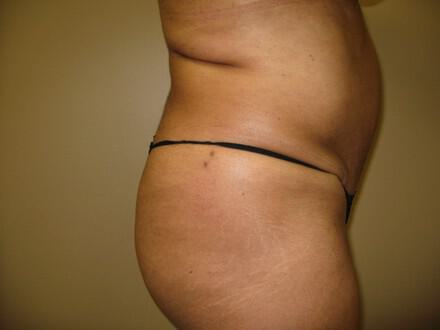Buttocks Reshaping Before & After Image
