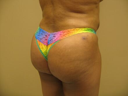 Buttocks Reshaping Before & After Image